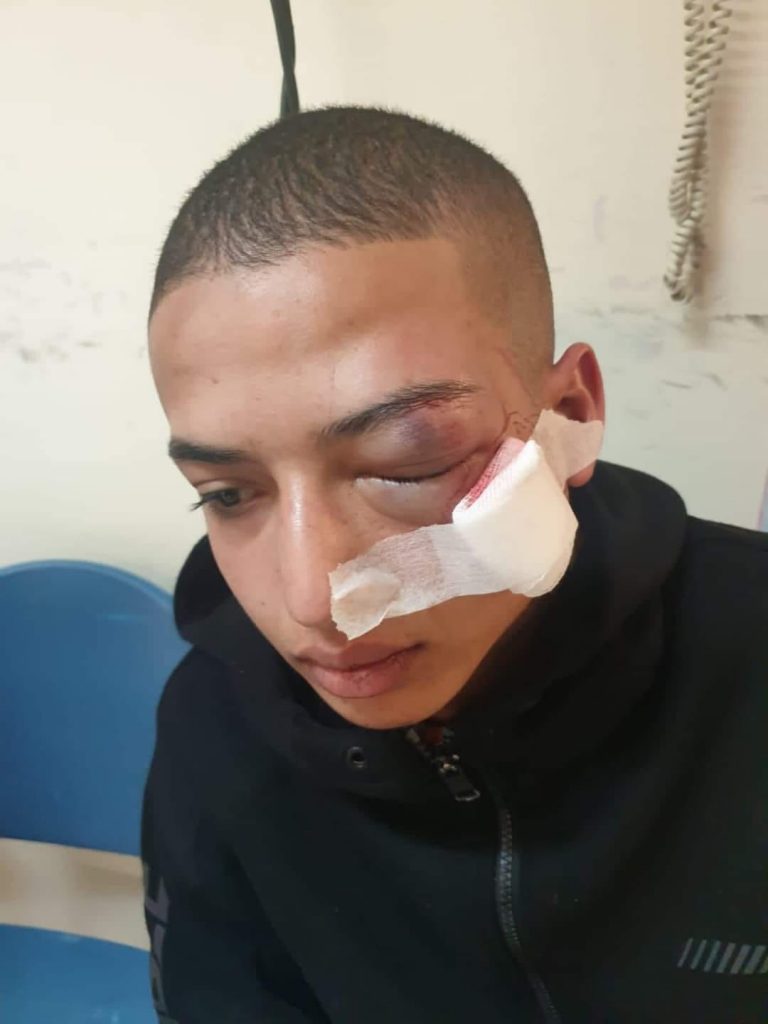 Jerusalemite kid injured by Israeli gunfire in Issawiya